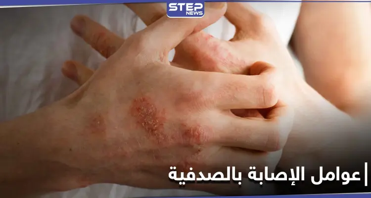 الصدفية تزداد في الفترة الأخيرة.. وهؤلاء الأشخاص هم الأكثر عرضة للإصابة بها: أخبار