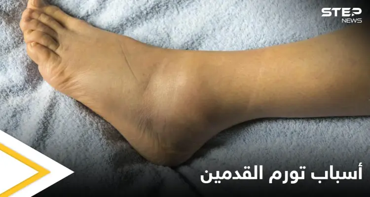 تعرف على أسباب تورم القدمين عند الرجال الأمراض المرتبطة بها: أخبار