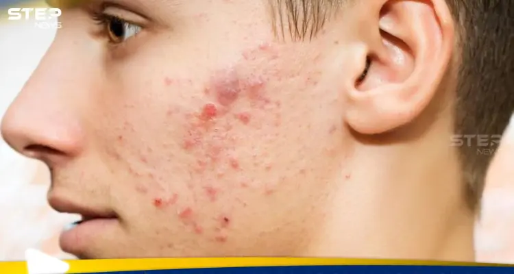 حب الشباب في الشتاء… لماذا يزداد ظهوره وكيف يمكن السيطرة عليه؟