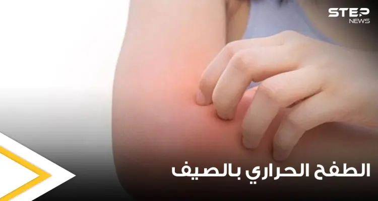 الطفح الحراري في الصيف أعراضه وأسبابه وطرق علاجه: أخبار