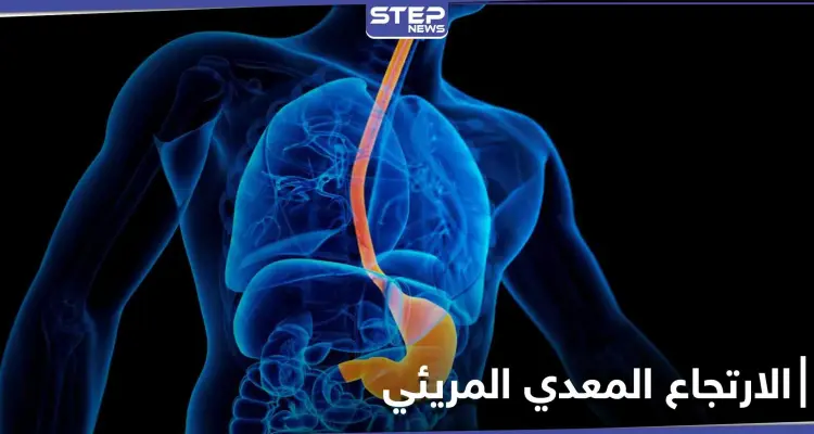 كيف تتخلص من آلام الارتجاع المعدي المريئي وما هي أسبابه وأعراضه الشائعة: أخبار