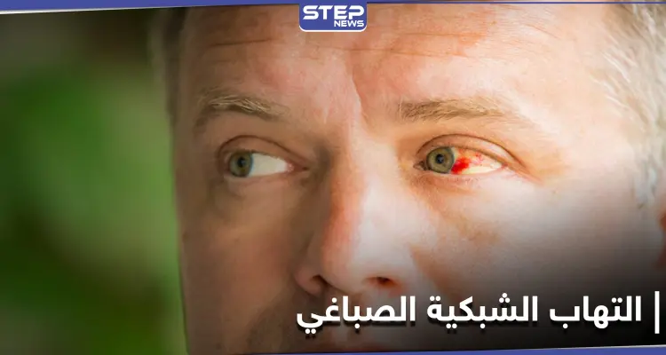 أخطر الإصابات العينية.. التهاب الشبكية الصباغي تعرّف إلى أعراضه وعلاجاته: أخبار