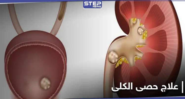 ما لا تعرفه عن حصى الكلى وكيف يمكن معالجتها بالوسائل المنزلية البسيطة: أخبار