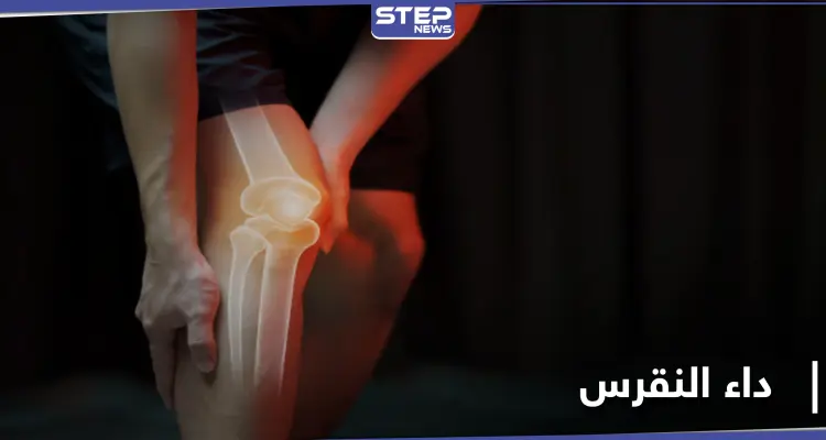 عوامل تزيد من خطر الإصابة بـ داء النقرس: أخبار