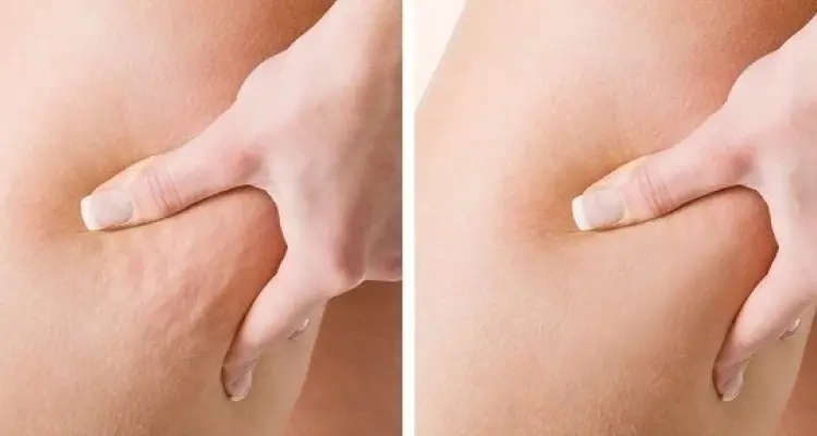 عملية إزالة السيلوليت.. مع تعريفه وطرق إزلته بالليزر بتقنية حديثة: أخبار