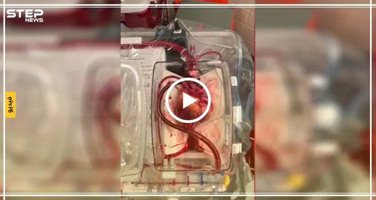 في خطوة قد تنقذ الآلاف.. أطباء ينجحون بإعادة النبض إلى قلب ميت (فيديو): أخبار