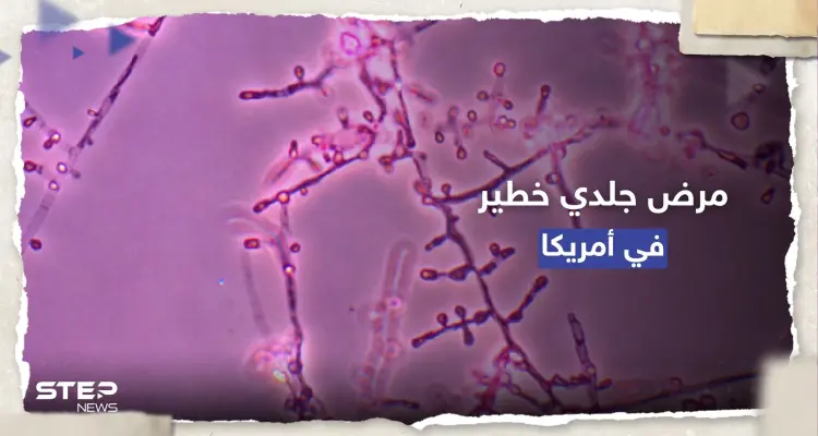 معدي ومقاوم للأدوية.. تسجيل أول إصابتين بمرض جلدي خطير في أمريكا: أخبار