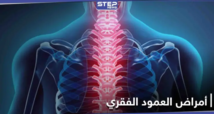 منها السُمنة.. تعرف على أسباب الأمراض التي تصيب العمود الفقري ومدى خطورتها وطرق العلاج: أخبار