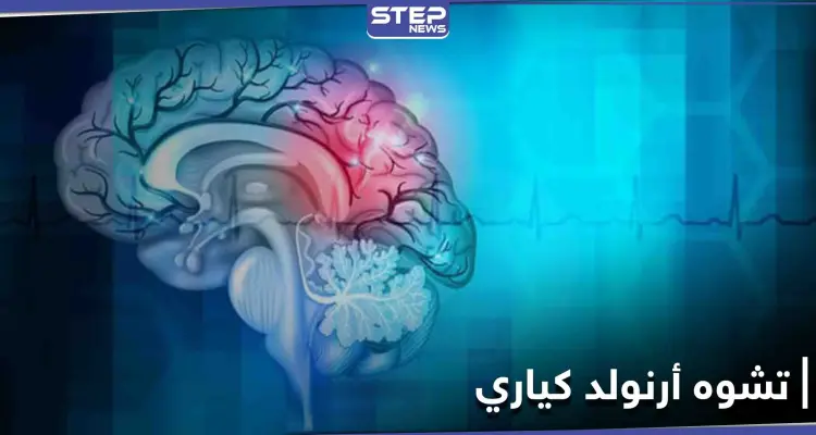 ماذا تعرف عن تشوه أرنولد كياري وأثره على النخاع الشوكي والحركة العضلية: أخبار