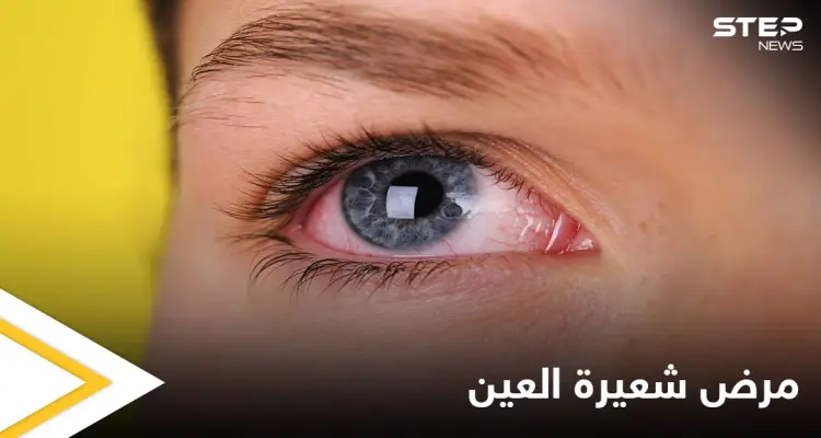 ما هي شعيرة العين وأسباب ظهورها إليك أهم المعلومات: أخبار