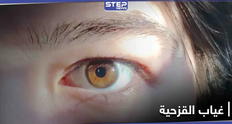 مخاطر مرض غياب القزحية وأسبابه وطرق العلاج: أخبار