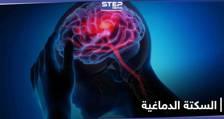 السكتة الدماغية تنهي حياة أعداد كبيرة يومياً.. أعراضها وطرق الوقاية منها: أخبار