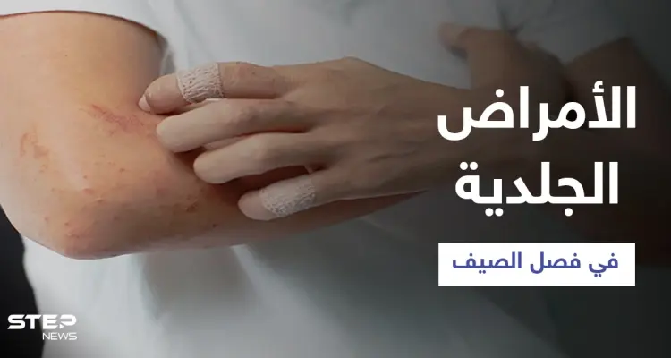 تعرّف على أبرز الأمراض الجلدية الشائعة في فصل الصيف وطرق الوقاية منها: أخبار