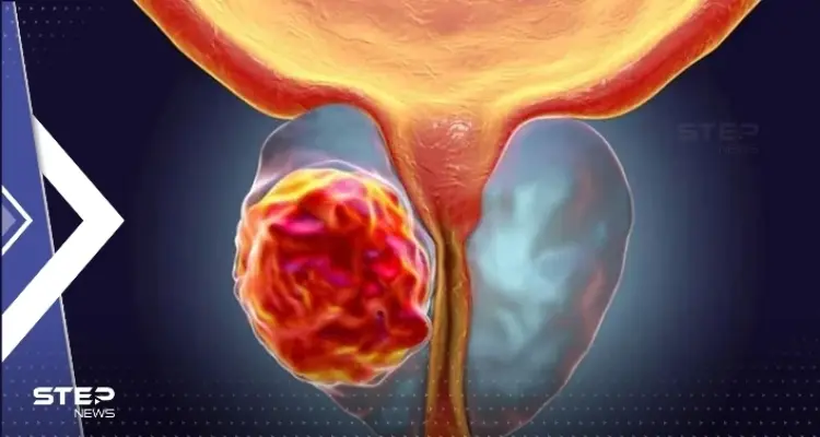 باحثون يكشفون لأوّل مرّة عن إنزيم يمكن استهدافه لقتل سرطان البروستات: أخبار