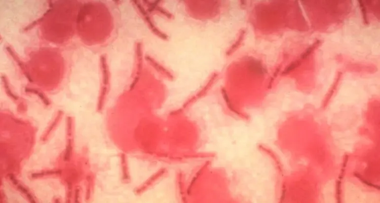 بعد الفطر الأسود.. عدوى بكتيرية خطيرة قد تنتشر في العراق بعد وقوع 5 إصابات مؤكدة بها: أخبار