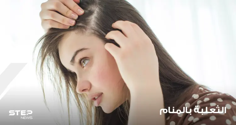 تفسير رؤية الثعلبة في الرأس بالحلم وتفسير سقوط الرموش و الحواجب في المنام: أخبار