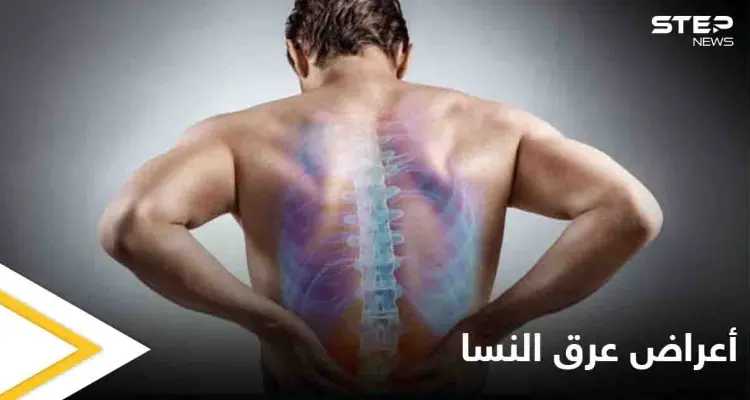 5 أعراض تخبرك بأنك مصاب بمرض عرق النسا تعرف عليها: أخبار