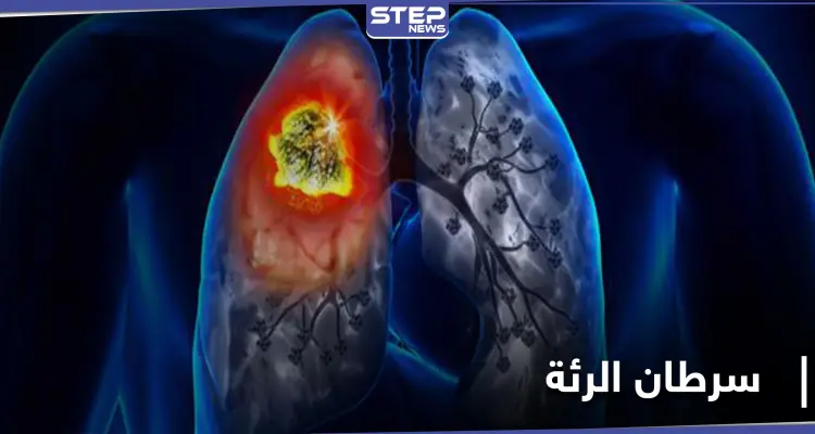 أورام غير متوقعة قد تكون دليلًا على الإصابة بـ سرطان الرئة: أخبار