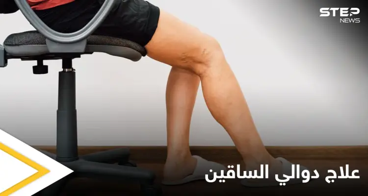 تعرف على أهم الوصفات الطبيعية لعلاج دوالي الساقين: أخبار