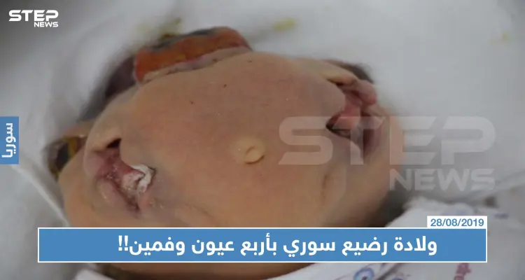 حالة نادرة: ولادة رضيع سوري بأربع عيون وفمين!!: أخبار