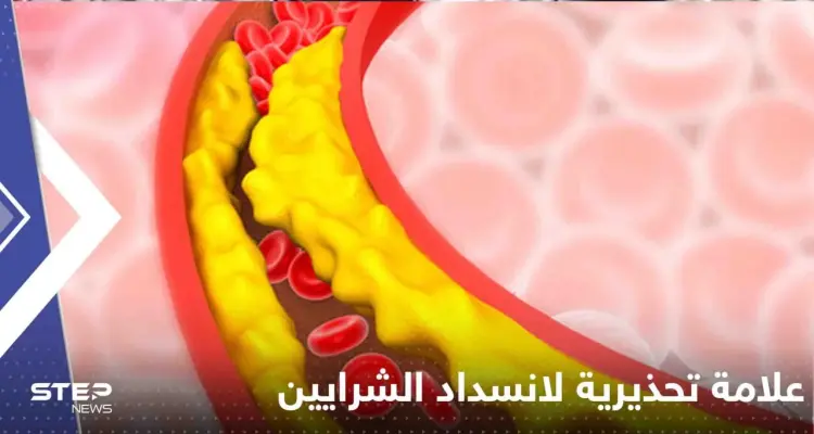 علامة تحذيرية بسيطة تكشف انسداد الشرايين بسبب الكوليسترول.. إياك تجاهلها: أخبار