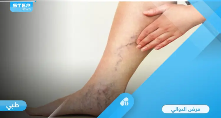 ما هي الدوالي وأسبابها الأعراض الشائعة وطرق علاجها إليك أهم المعلومات: أخبار