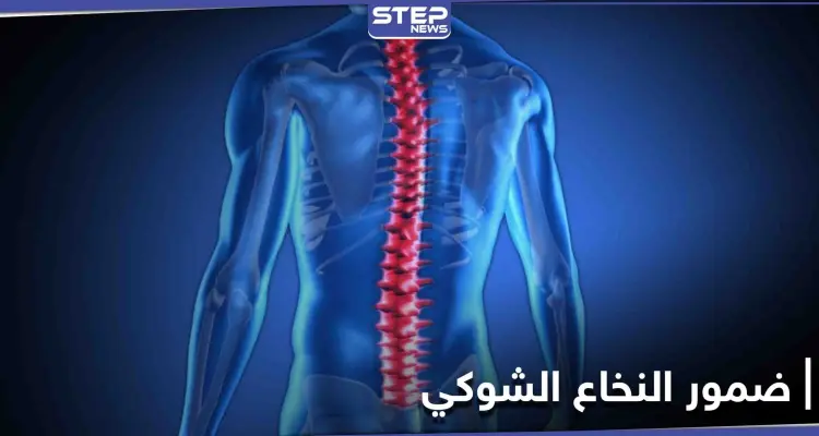 تعرف على مرض ضمور النخاع الشوكي أسبابه ومراحل خطورته على حياة الإنسان: أخبار