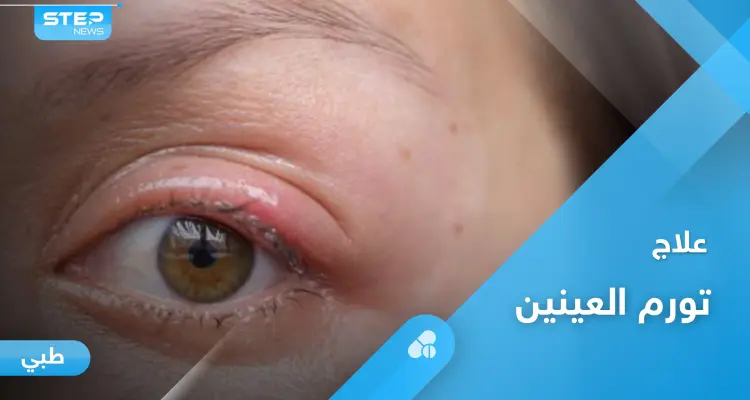 هل تعاني من تورم العينين.. إليك أهم الأسباب وطرق العلاج في المنزل: أخبار