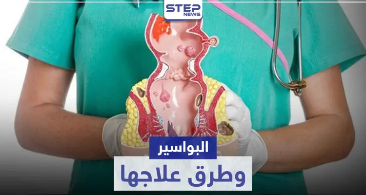 أفضل علاج للبواسير في المنزل و الصيدليات: أخبار