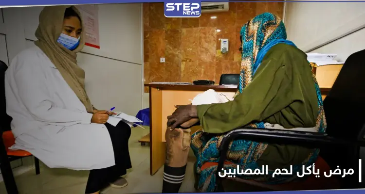 "يأكل لحم المصابين".. مرض المايستوما يتطور خلسة في السودان ويصيب الآلاف: أخبار