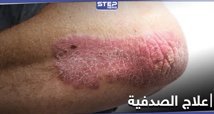 أثر النظام الغذائي على علاج الصدفية.. أنواعها وطرق الوقاية منها: أخبار