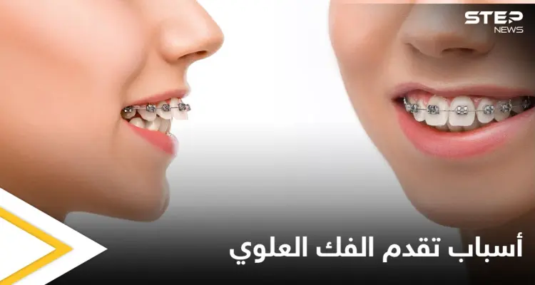 هل هي الوراثة.. الكشف عن أسباب تقدم الفك العلوي وأعراضه وطرق العلاج: أخبار