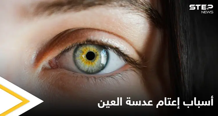 التدخين أحد أسبابه.. إعتام عدسة العين وخطورته وأبرز المسببات لحدوثه إليك اهم المعلومات: أخبار