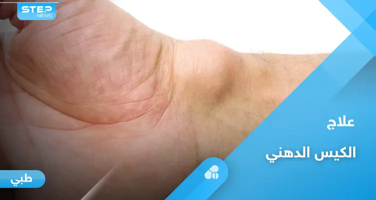 الكيس الدهني.. هل هو خطير وأبرز أعراضه وعلاجه إليك أهم المعلومات: أخبار