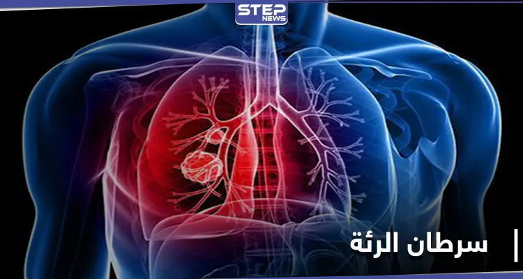 علامة تظهر في منطقة العين تدلُّ على الإصابة بـ سرطان الرئة.. إليك التفاصيل: أخبار