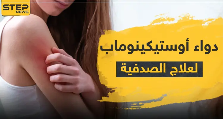 دواء أوستيكينوماب لعلاج الصدفية: أخبار