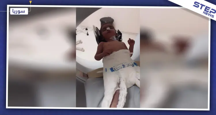 إهمال طفل مهجّر في مشفى الباب، ورفض تركيا إدخاله تتسبب بفقدانه أطرافه وبصره!!: أخبار