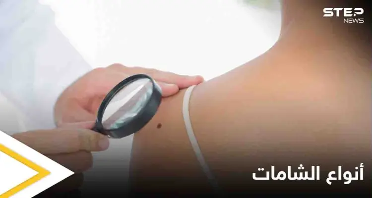 ماهي الشامة وهل لها علاقة بسرطان الجلد تعرف على أنواعها: أخبار