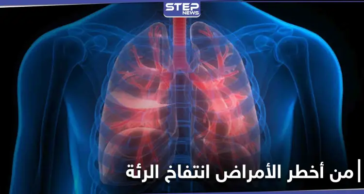 من أعراضه ضيق التنفس والإرهاق المستمر تعرف على مرض انتفاخ الرئة وطرق علاجه: أخبار