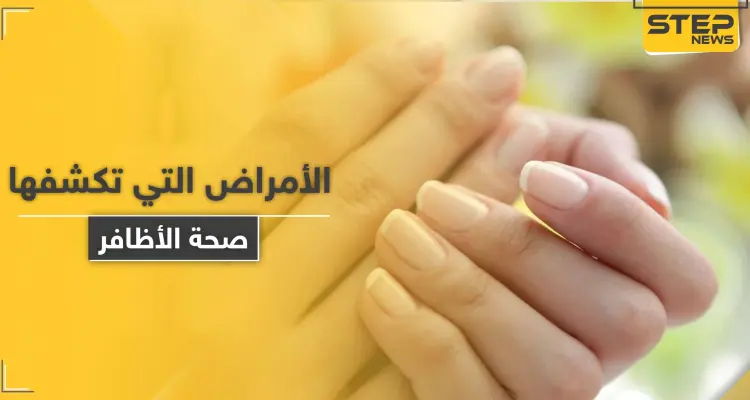 ما الأمراض التي تكشفها صحة الأظافر وألوانها وأشكالها في جسم الإنسان: أخبار