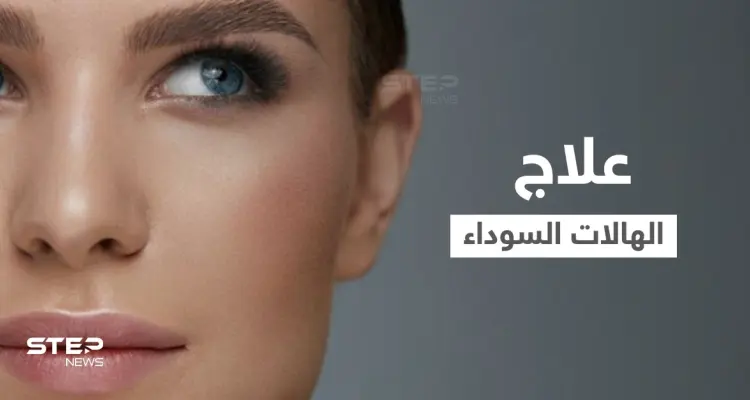 علاج الهالات السوداء "ازرقاق تحت العين" في المنزل وبطرق طبية إليك أهم المعلومات: أخبار