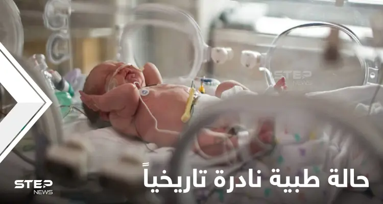 بحالة طبية نادرة للغاية.. ولادة طفل برازيلي بذيل بشري حقيقي مع كرة بنهايته (صور): أخبار