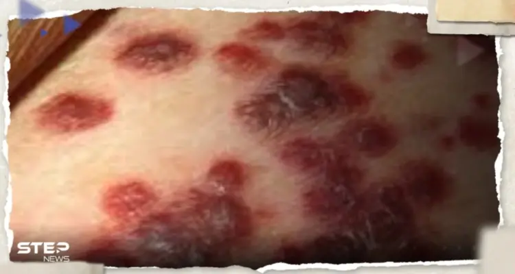 أمريكا تُحذّر من بكتيريا خطيرة آكلة للحوم.. إليك أبرز أعراضها: أخبار