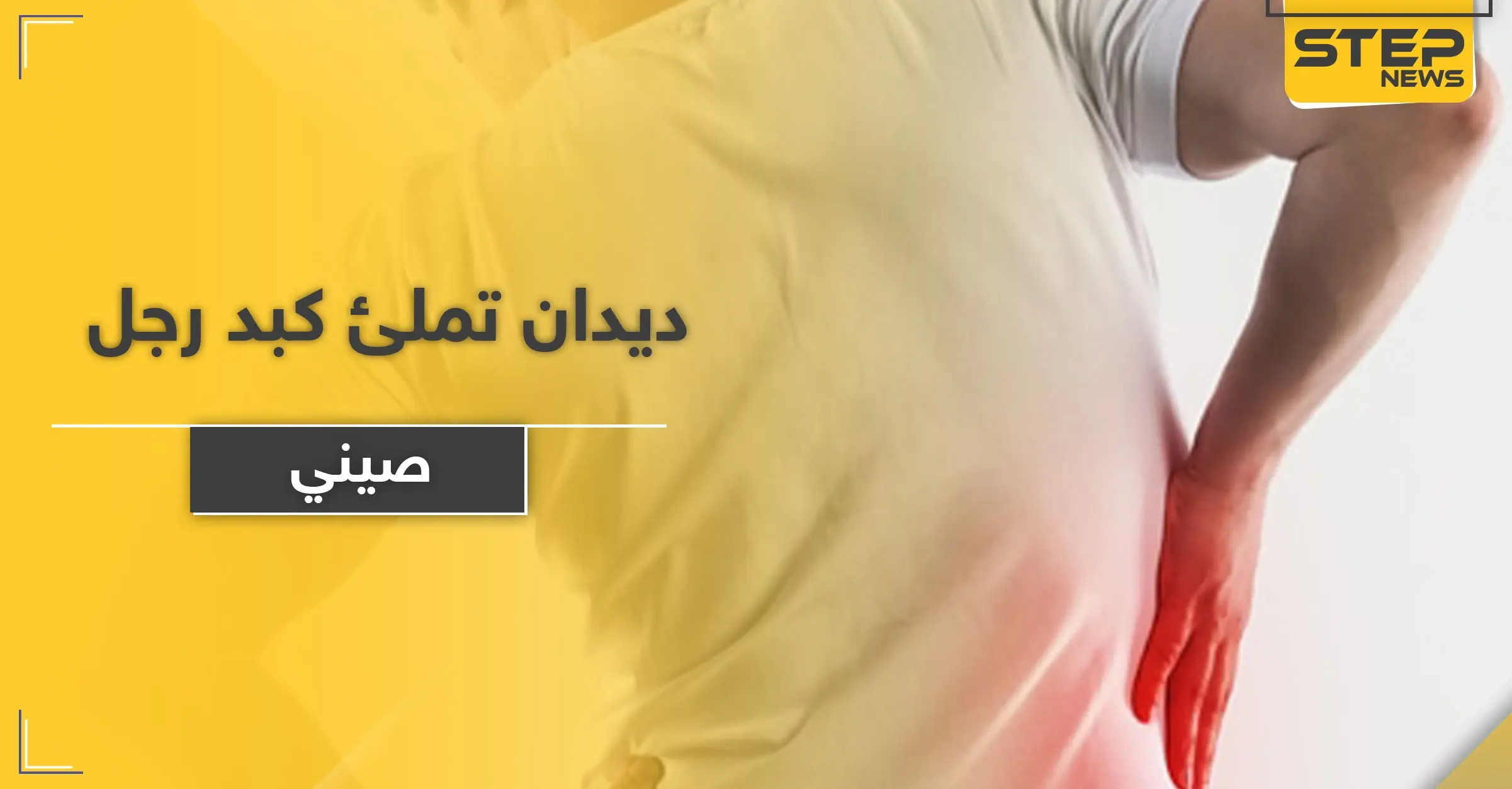 بالصور|| ديدان تملئ كبد رجل صيني.. والأطباء يضطرون لإستئصال جزء كبير منه ويوضحون الأسباب: الديدان