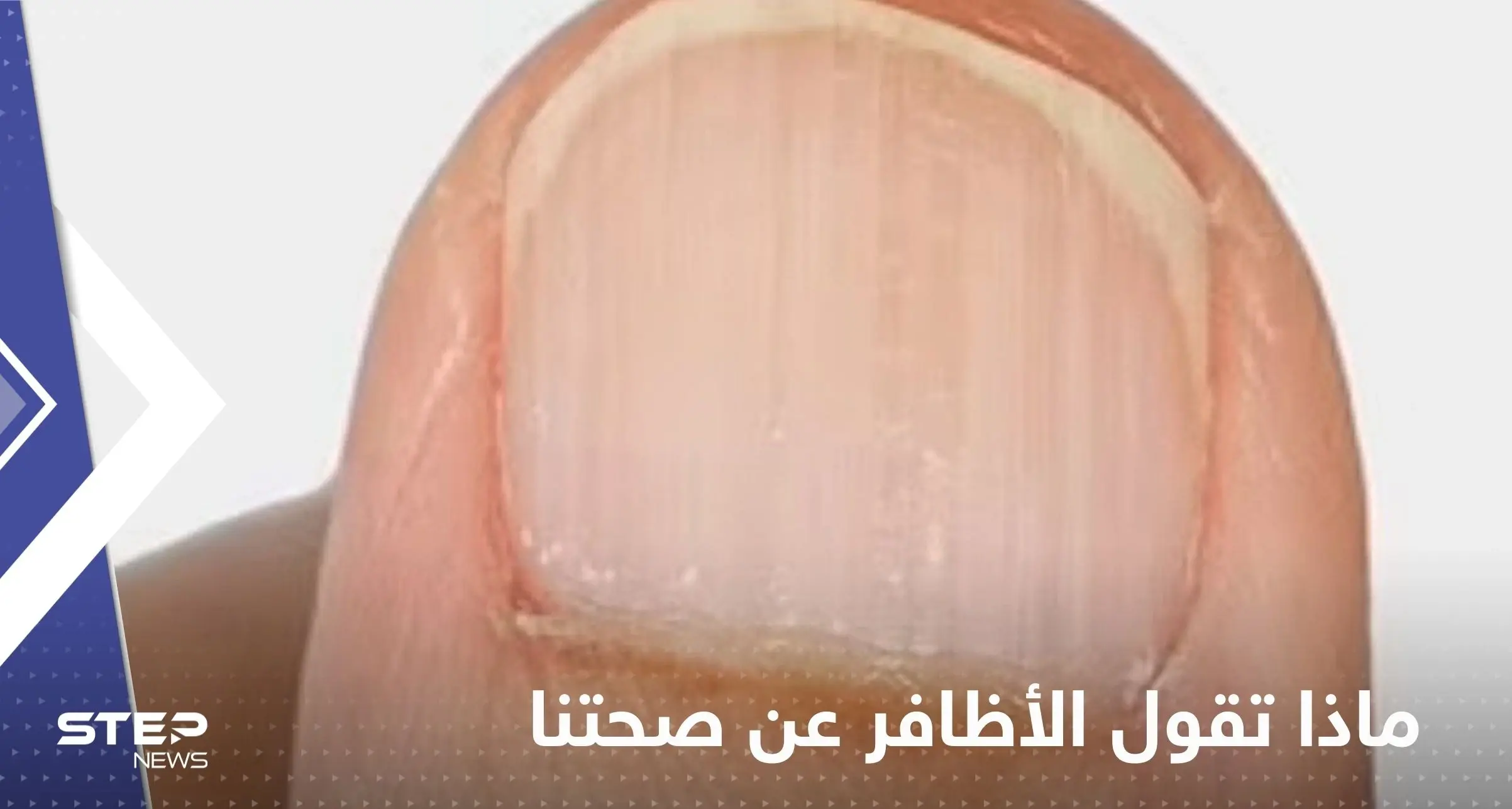 ماذا تقول الأظافر عن صحتنا؟.. تعرف على الحالات الخطيرة: صحة الأظافر