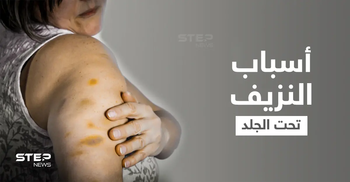 نزيف تحت الجلد... علامات أرجوانية أشبه بالكدمات على الجسم ما هي أسبابها وطرق علاجها: الصحة