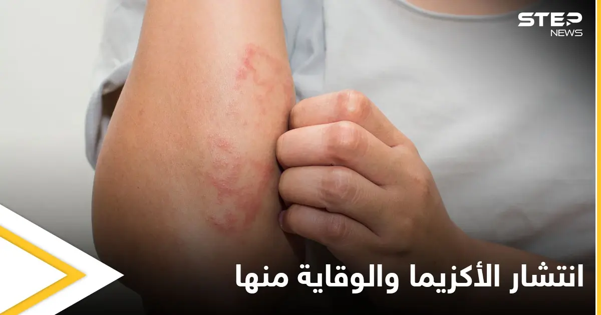 هل تنتشر الأكزيما في الجسم.. وطرق الوقاية منها إليك أهم المعلومات: علاج