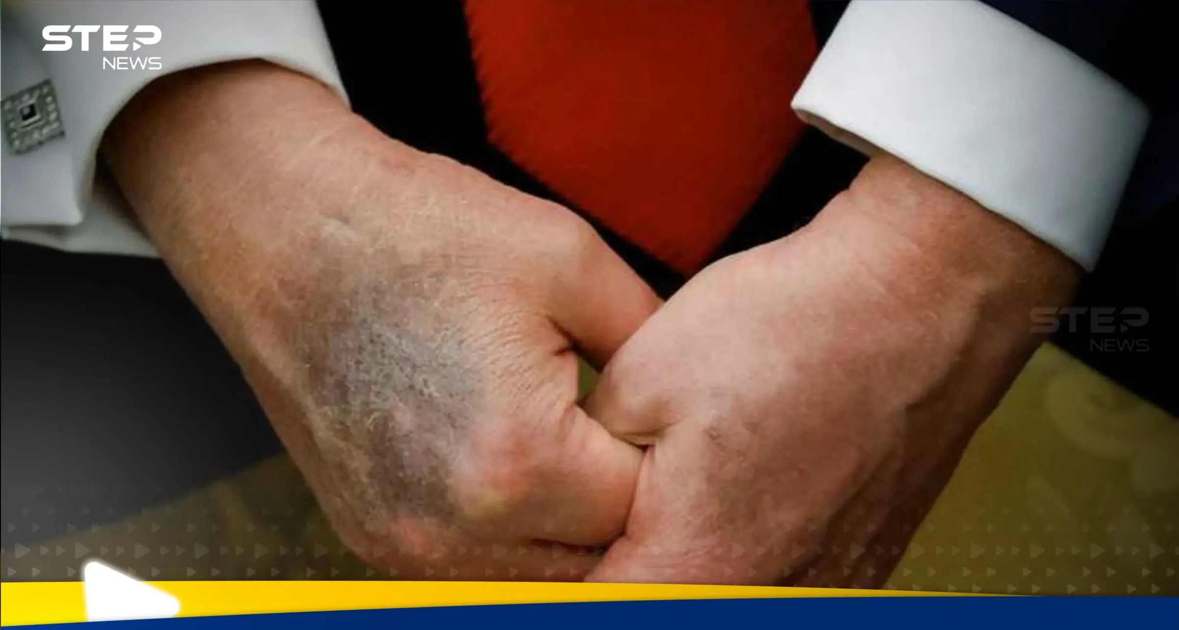 شاهد|| كدمات داكنة على يد ترامب تثير المخاوف مجدداً حول صحته: اخبار أمريكا