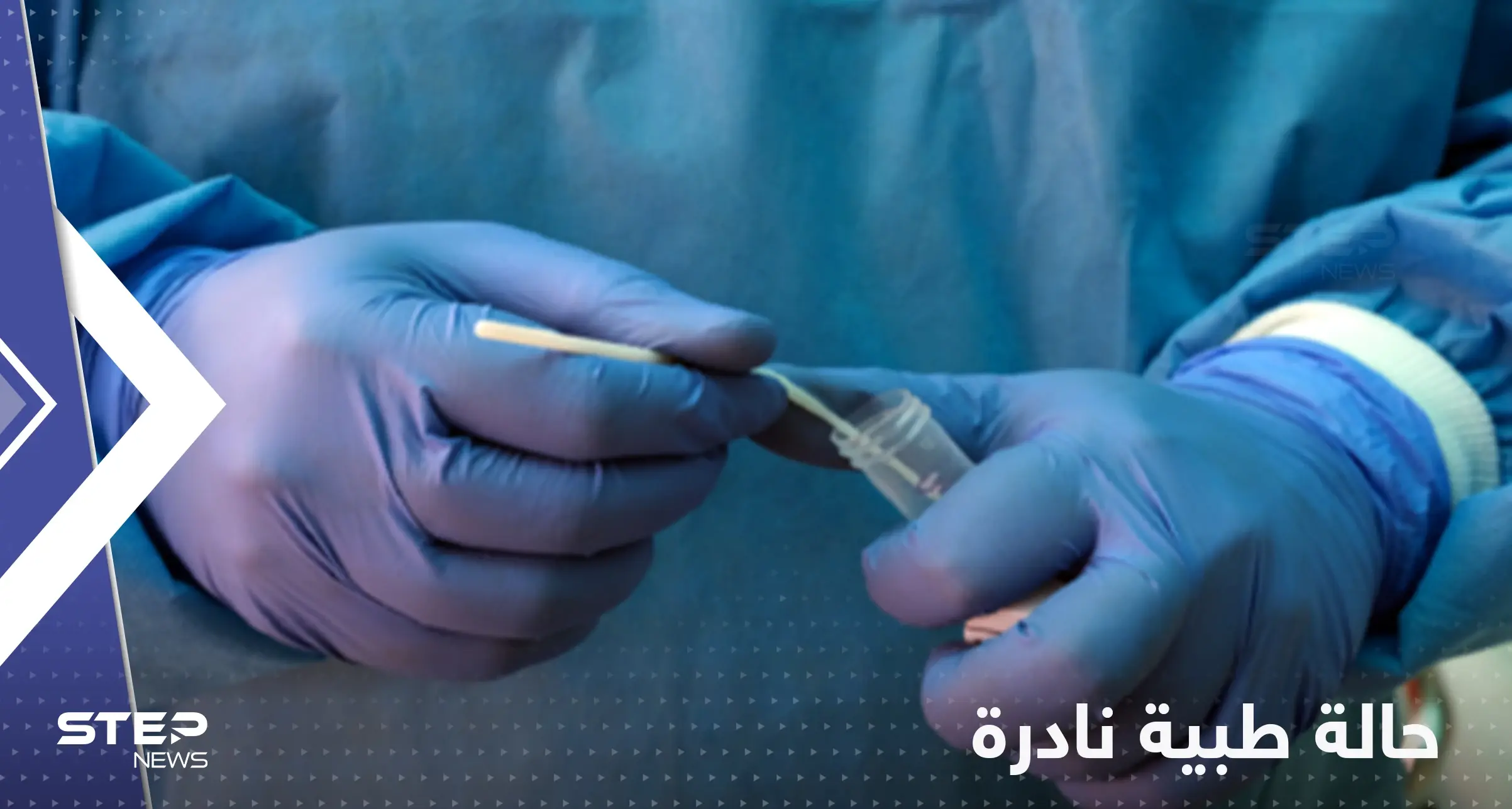 الإعلان لأول مرة عن شخص مصاب بكورونا والإيدز وجدري القردة معاً: جدري القردة