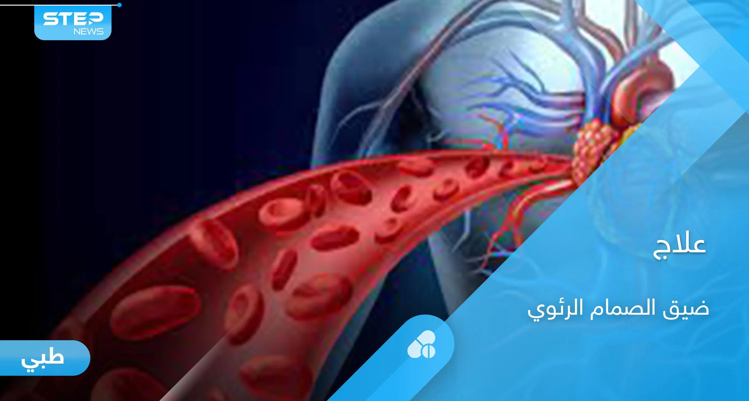 خطورة ضيق الصمام الرئوي وطرق العلاج.. إليك أهم المعلومات: الصمام الرئوي